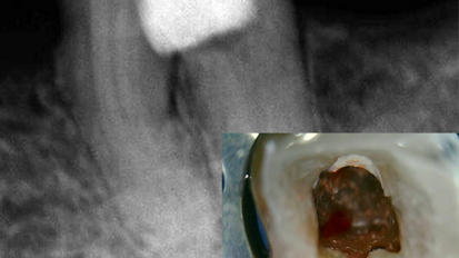 Tratamiento de perforación con el nuevo MTA Repair HP