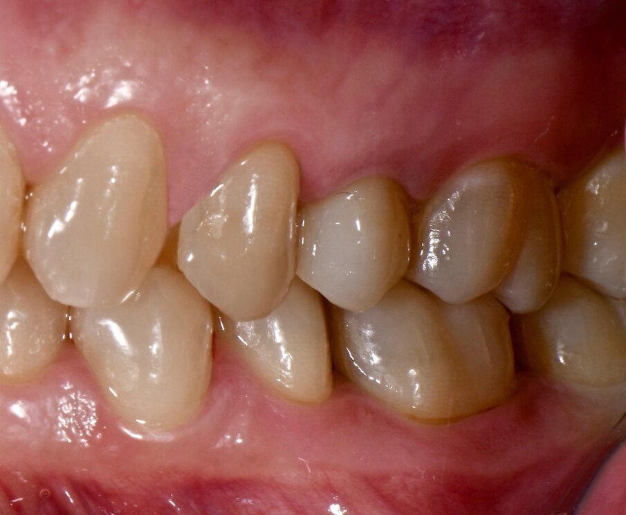 Fig. 5c - Condizione clinica ad 1 anno: III e IV sestante.
