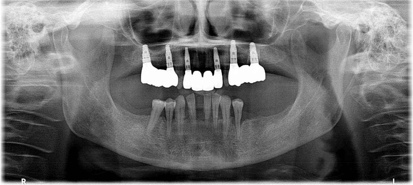 Fig. 17: Final radiograph with definitive prosthetic superstructures in place.