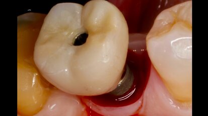 Interacción entre factores protésicos y sistémicos en la periimplantitis 