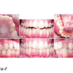 Ortodontická léčba komplexních případů malokluze pomocí průhledných alignerů