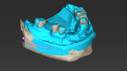 coDiagnostiX merging of DICOM and STL files