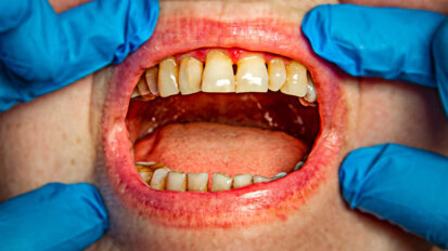 Badania wskazują, że zapalenie przyzębia może podwoić ryzyko pogorszenia funkcji poznawczych