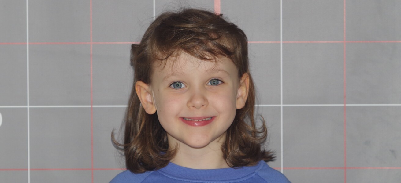 Fig. 12b: Initial facial photograph: frontal facial view during smiling, showing persistence of asymmetries.