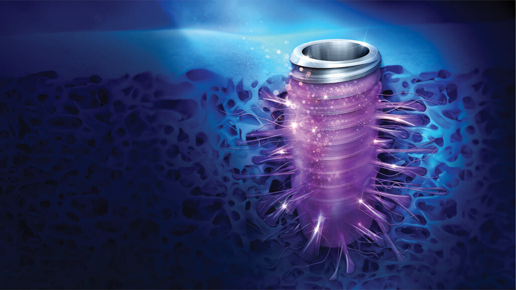 Osseointegration of the future with Osstem’s TSIII SOI implant