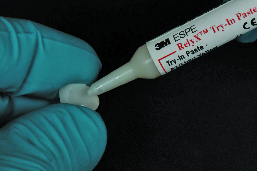 Fig. 9: Try in of the restorations with 3M™ RelyX™ Try-In Paste to determine the optimal cement shade.