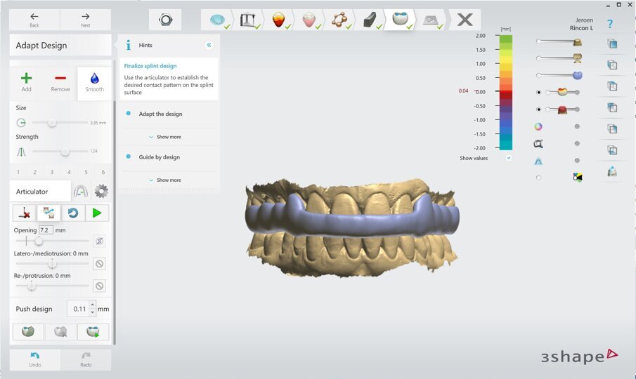 Obr. 5: Rozšíření dlahy na labiální plochy špičáků pro zlepšení retence a zabránění
dislokace při artikulaci.