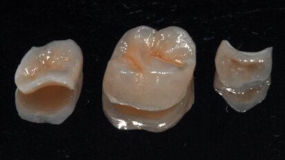 Restauri adesivi indiretti nei settori posteriori