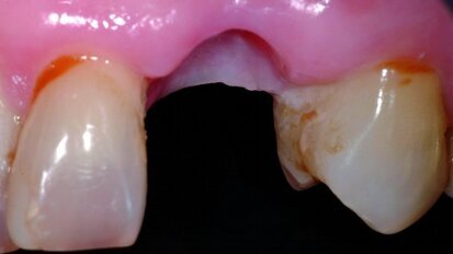 Préservation de la crête alvéolaire après extraction