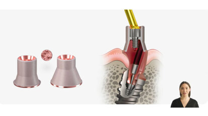 Keystone Dental Group – Genesis Active – Innovative Multi-Unit Abutment Solutions