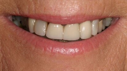 Intérêt des provisoires dans les cas de reconstructions complexes