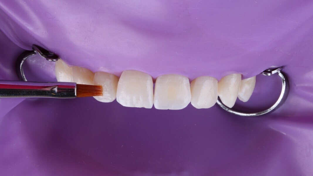 Fig. 12: Een borsteltje helpt bij het vormen en verdelen van het composiet op het tandoppervlak.