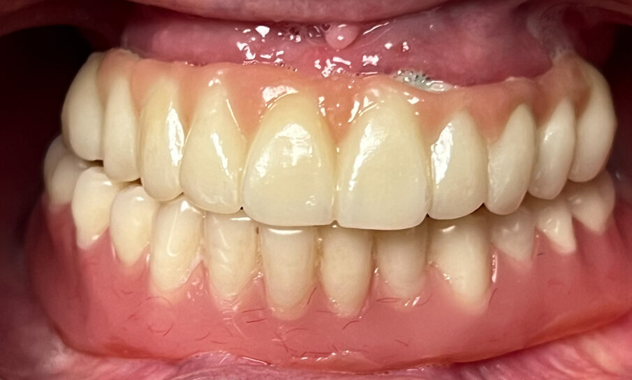 Fig. 2_Fotografia intraorale: la paziente riferisce dolore e sanguinamento all’arcata superiore con stabilità compromessa della protesi inferiore.