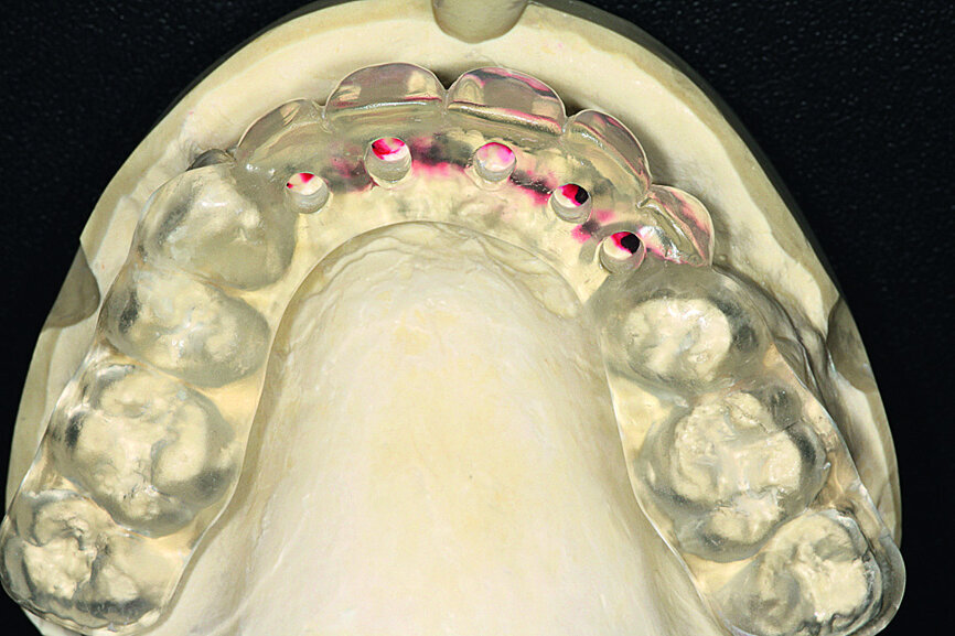 Fig. 12: A key of the added wax was taken and fabricated in clear casting resin.