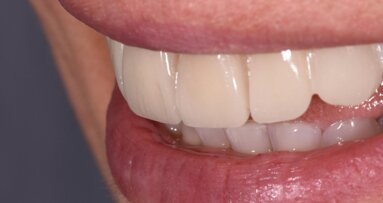 Ozonoterapia odontoiatrica ed estetica dentale: un connubio chimico e biologico