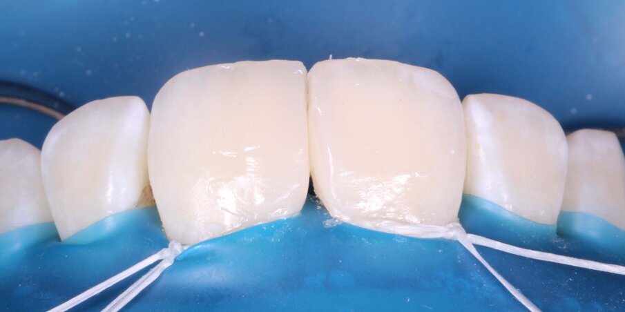 Fig 11. Tight Contacts formed