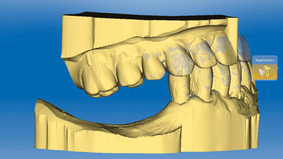 Efficienza del flusso digitale nelle riabilitazioni implantoprotesiche: Virtual Rehabilitation Concept (VRC)