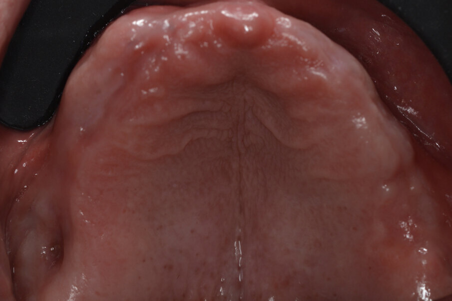 Fig. 11_Visione occlusale di un mascellare edentulo.