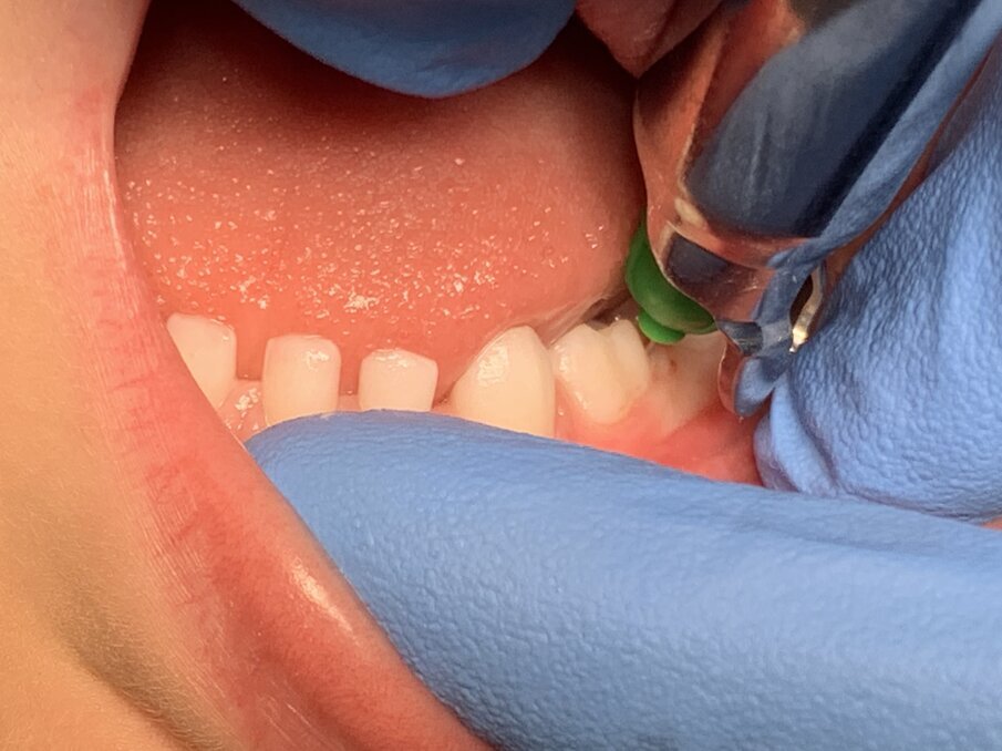 Afbeelding 3. Intraossale injectie.