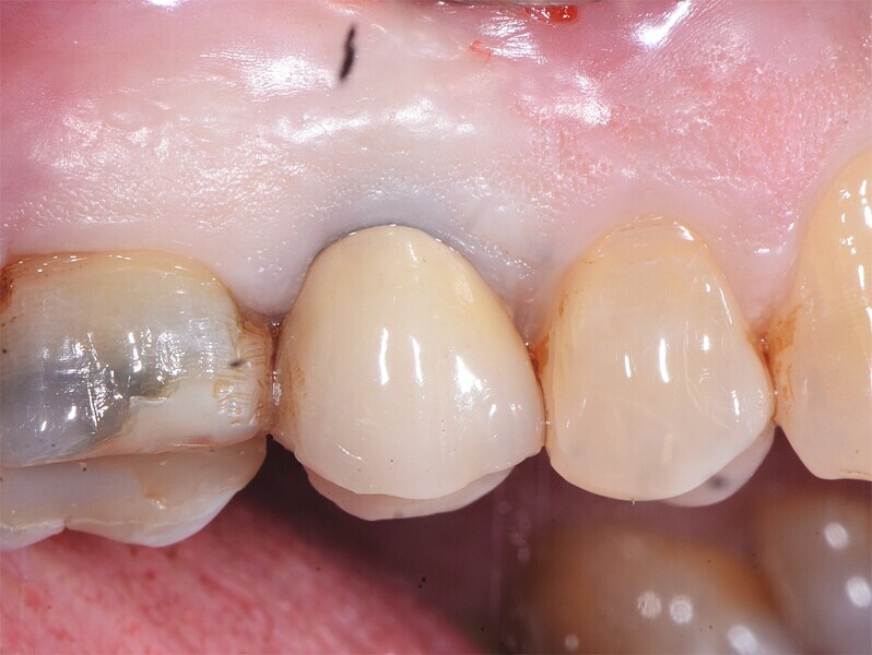 Fig. 13 : Dent irrécupérable. 
