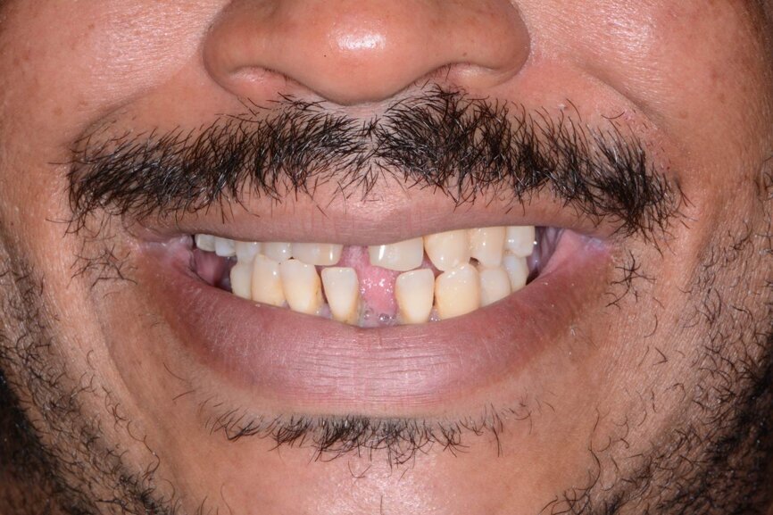 Fig. 1: Retracted pre-op smile view.