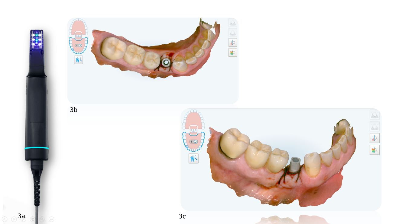 Fig. 3a–c: Intra-oral scanning with iTero Lumina scanner (a) proceeded with the capture of the implant’s spatial position on the master model after the implant scan body had been screwed in: occlusal (b) and buccal (c) view.