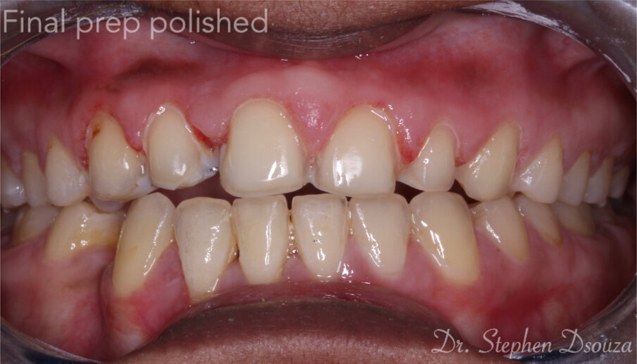 Fig. 10: Final preparation.