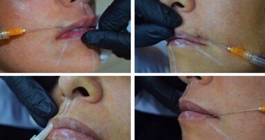 Dentistas y Médicos son los únicos que pueden usar botox y ácido hialurónico