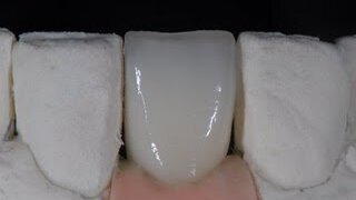 Zimmer: Γωνιώδη κολοβώματα ζιρκονίου παρέχουν μία εξυπηρετική αισθητική λύση