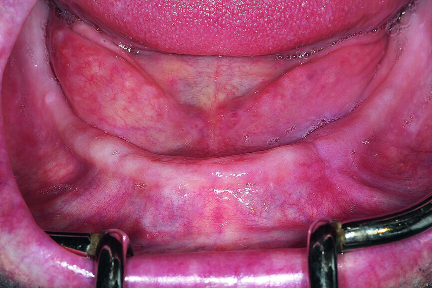 Fig. 4: Edentulous resorbed mandibular ridge.