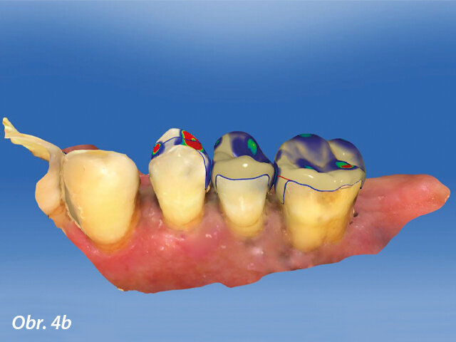 Ilustrační snímek z CAD výroby v distálním úseku horní čelisti.