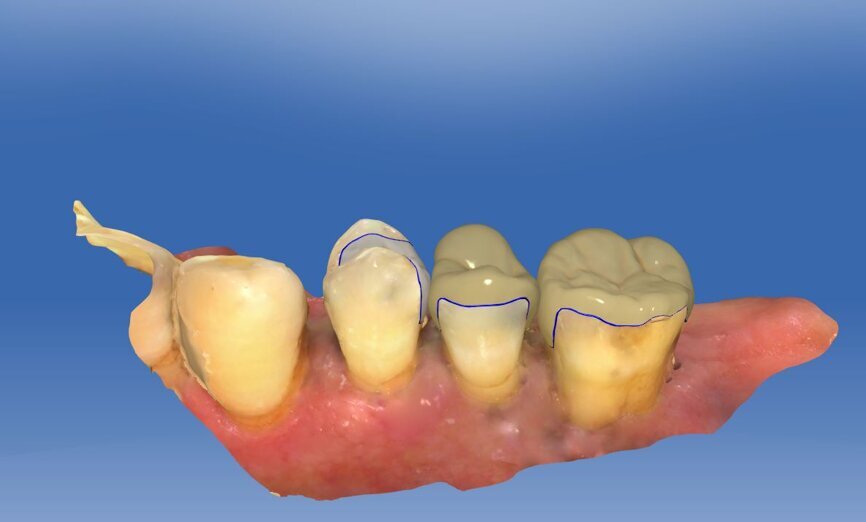 Fig. 4a: Illustrative image of the CAD construction in the posterior segment of the maxilla.