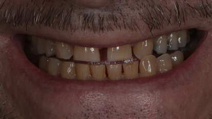 Revolutionising dental treatments: The power of digital integration with Invisalign Smile Architect