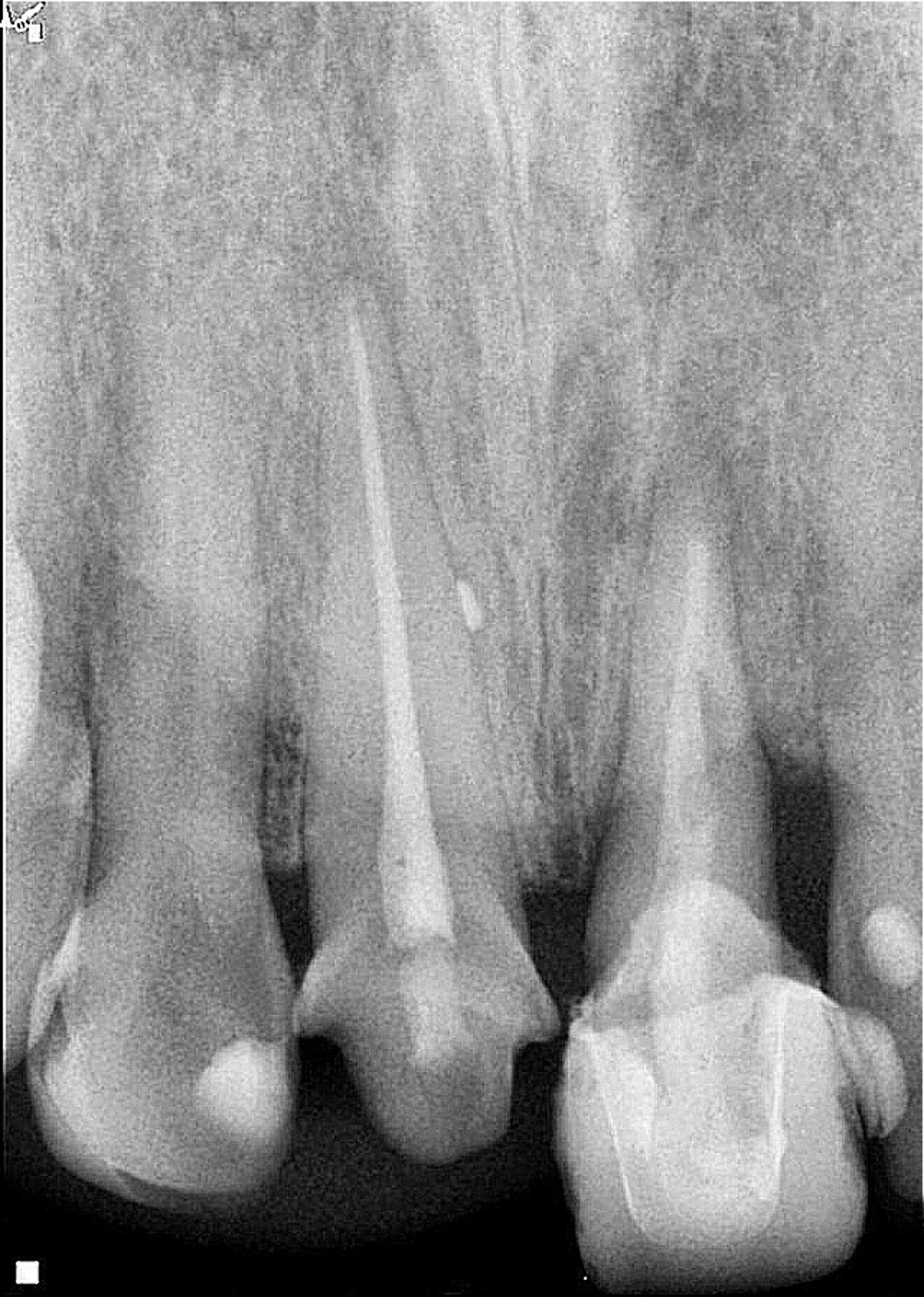 Fig. 3: Eight-week follow-up radiograph with the provisional crown in place showing bone remodelling of the mesial and distal aspects of the bone crest and periapical healing in progress. 