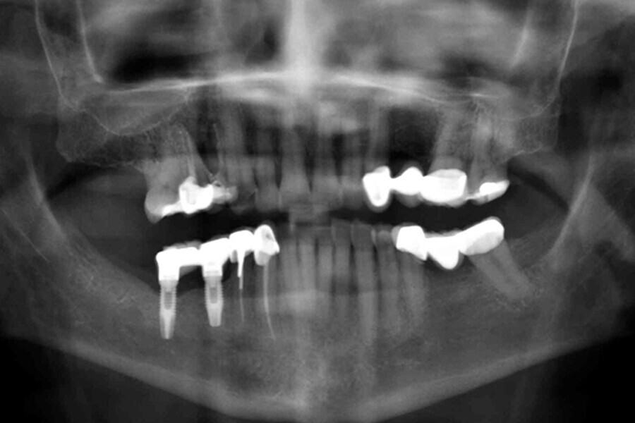 Fig. 2. Radiografía panorámica previa a la intervención quirúrgica.