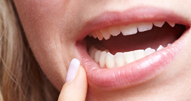 Neue S2k-Leitlinie zum Thema Aphthen veröffentlicht