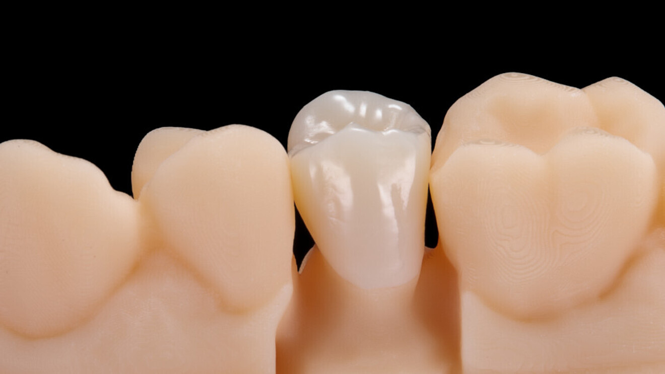 Fig. 2: The exact accuracy of fit and the homogeneous surface were impressive.