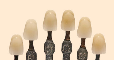 Възстановителни материали претърпяват промяна в цвета след поставянето