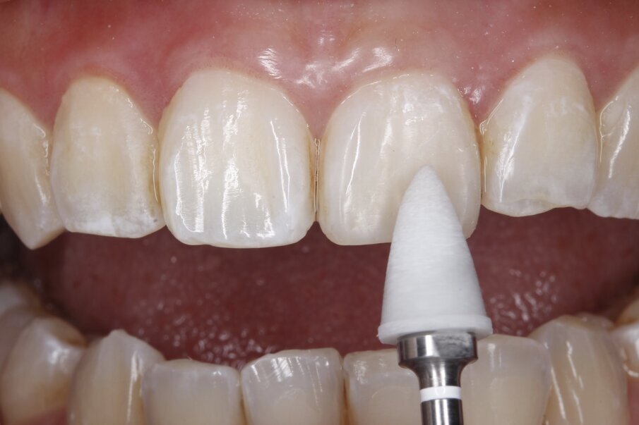 Fig 10: Surface texture achieved with OneGloss silicone polisher