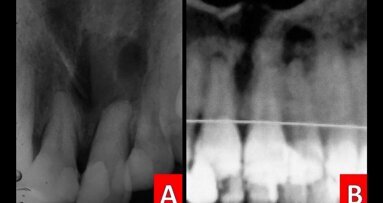 Tratamiento endoquirúrgico de periodontitis apical crónica y dientes supernumerarios