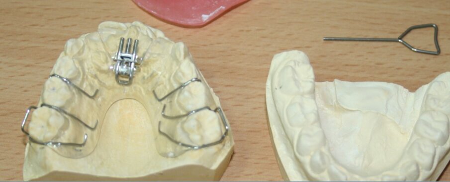 Fig. 13.  Upper removable orthodontic appliance with an anterior expanding palatal screw; to correct the cross bite of 11 & 21. The expansion key is on the right