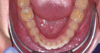 Ricostruzioni funzionali  nei settori posteriori con un nuovo composito altamente biocompatibile