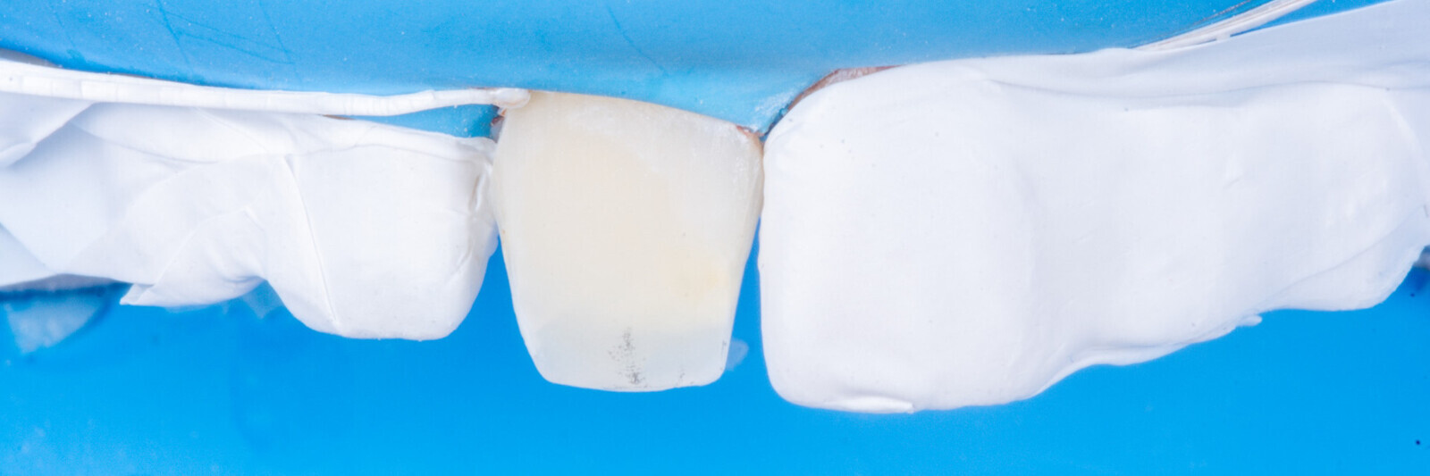 Fig. 15 : Isolation individualisée à l’aide de PTFE (teflon).