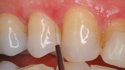 Diode lasers for periodontal treatment: the story thus far Diode lasers for periodontal treatment: the story thus far