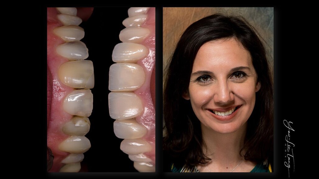 AMBER® MILL Lithiumdisilicaat – Freesblokjes met vrijheid in translucentie