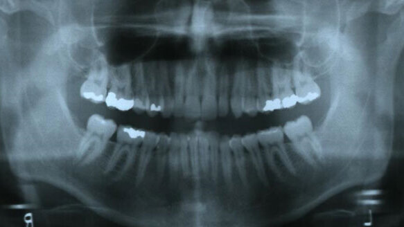 ClearCorrect treatment of crowding and constricted archforms