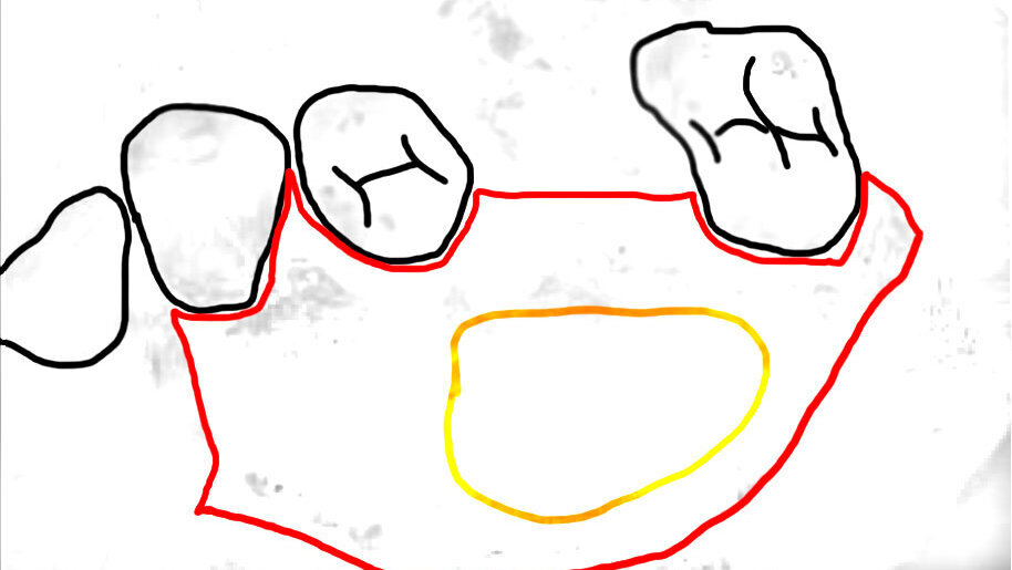 Kontrowersje wokół zabiegu podniesienia dna zatoki szczękowej od strony podniebiennej