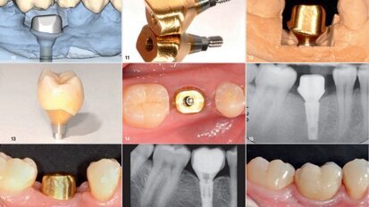 使用Atlantis镀金钛合金个性化基台达到解剖外形、支持强度和色泽一例