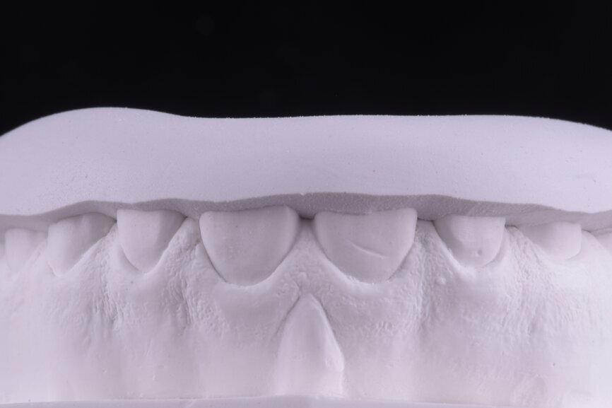 Fig. 41: Silicone index of the preparation for clinician control.