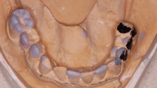 Implantoprotetyczna rehabilitacja braków skrzydłowych z pełną odbudową estetyczną